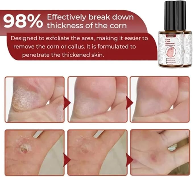 Feet Corn Removal Serum (Pack of 2) Feet Corn Removal Serum (Pack of 2) Zaavio®