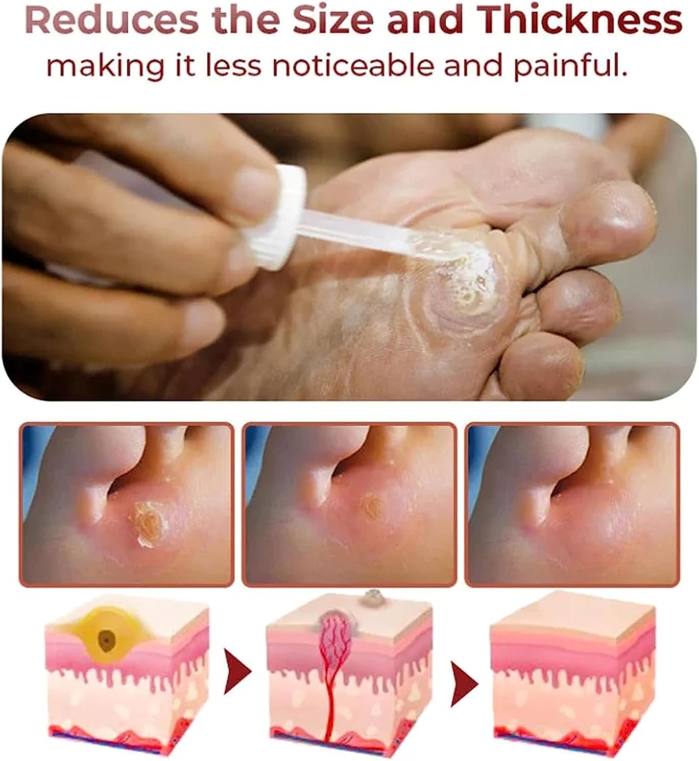 Feet Corn Removal Serum (Pack of 2) Feet Corn Removal Serum (Pack of 2) Zaavio®