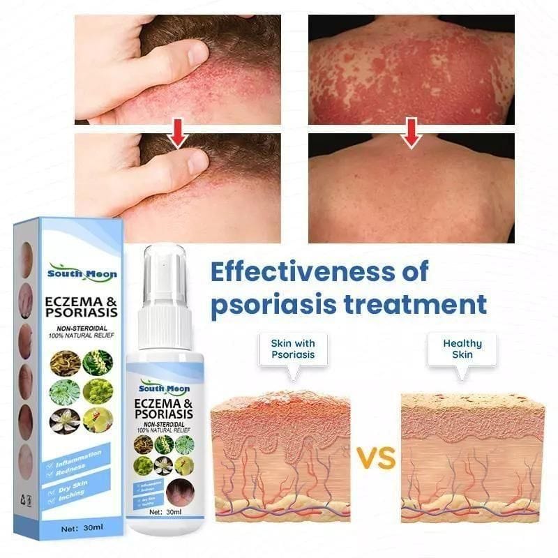 Herbal Psoriasis Relief Spray Herbal Psoriasis Relief Spray