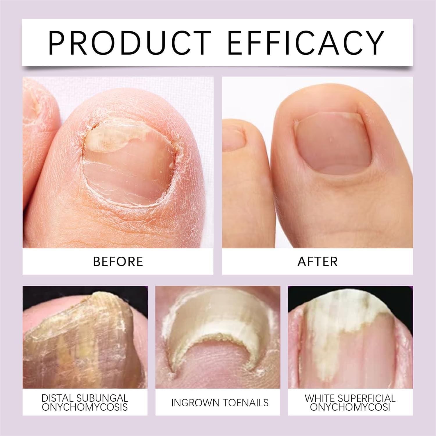 Nail Treatment Serum | Ingrown Toe nails Brittle Fingernails Nail Grown Serum Care Nail Treatment Serum (Set of 2)