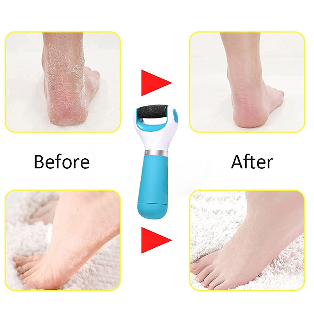 Pediflexy™️ | Callus Remover Foot Scrubber Dead Skin Remover For Feet Pediflexy™️Foot Roller Callus Remover Zaavio®
