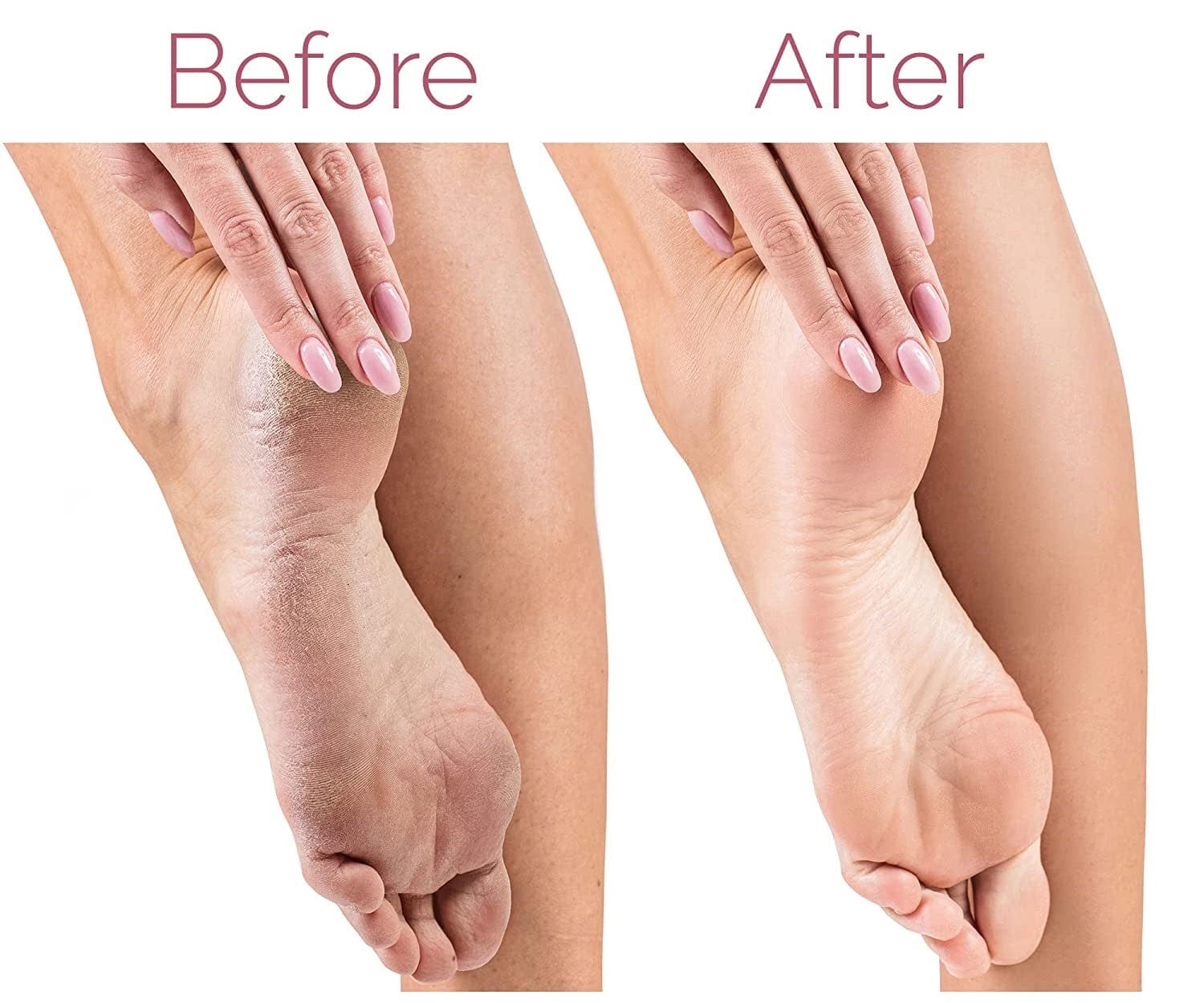 Scalli Pro™️ | Callus Remover Foot Treatment Cleaning Electric Callus Pads Scalli Pro™ Zaavio®
