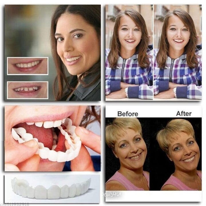 Snap-on Dentures | White Teeth Braces Clip On Veneer Teeth Perfect Dental Braces Snap-on Dentures