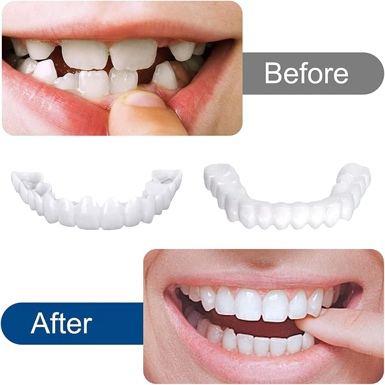 Snap-on Dentures | White Teeth Braces Clip On Veneer Teeth Perfect Dental Braces Snap-on Dentures