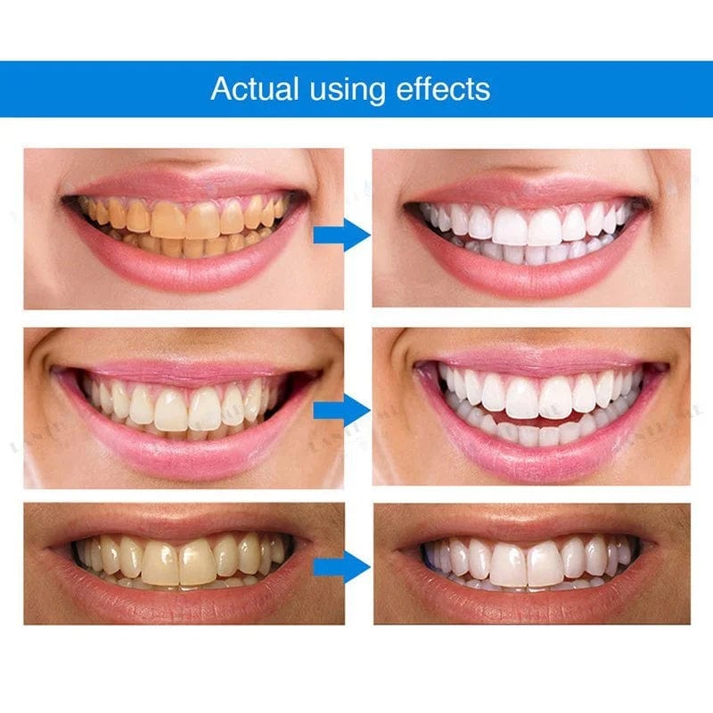 Teeth Whitening Pen Marker Whitening Products Instant Gel Treatment - Dentipen™️ Dentipen™️ Zaavio®