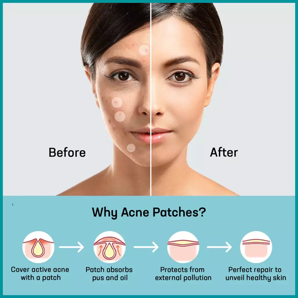 Acne Pimple Patch Blemish Spot Sticker Dots - Acne Pimple Patches - Set Of 72 Patches Acne Pimple Patches - Set Of 72 Patches