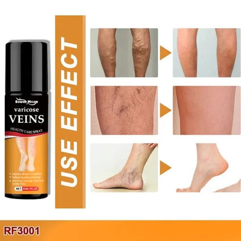 BEE VARICOSE VEINS RELIEF SPRAY (SET OF 2) Bee Venom Varicose Veins Relief Spray (Set Of 2)