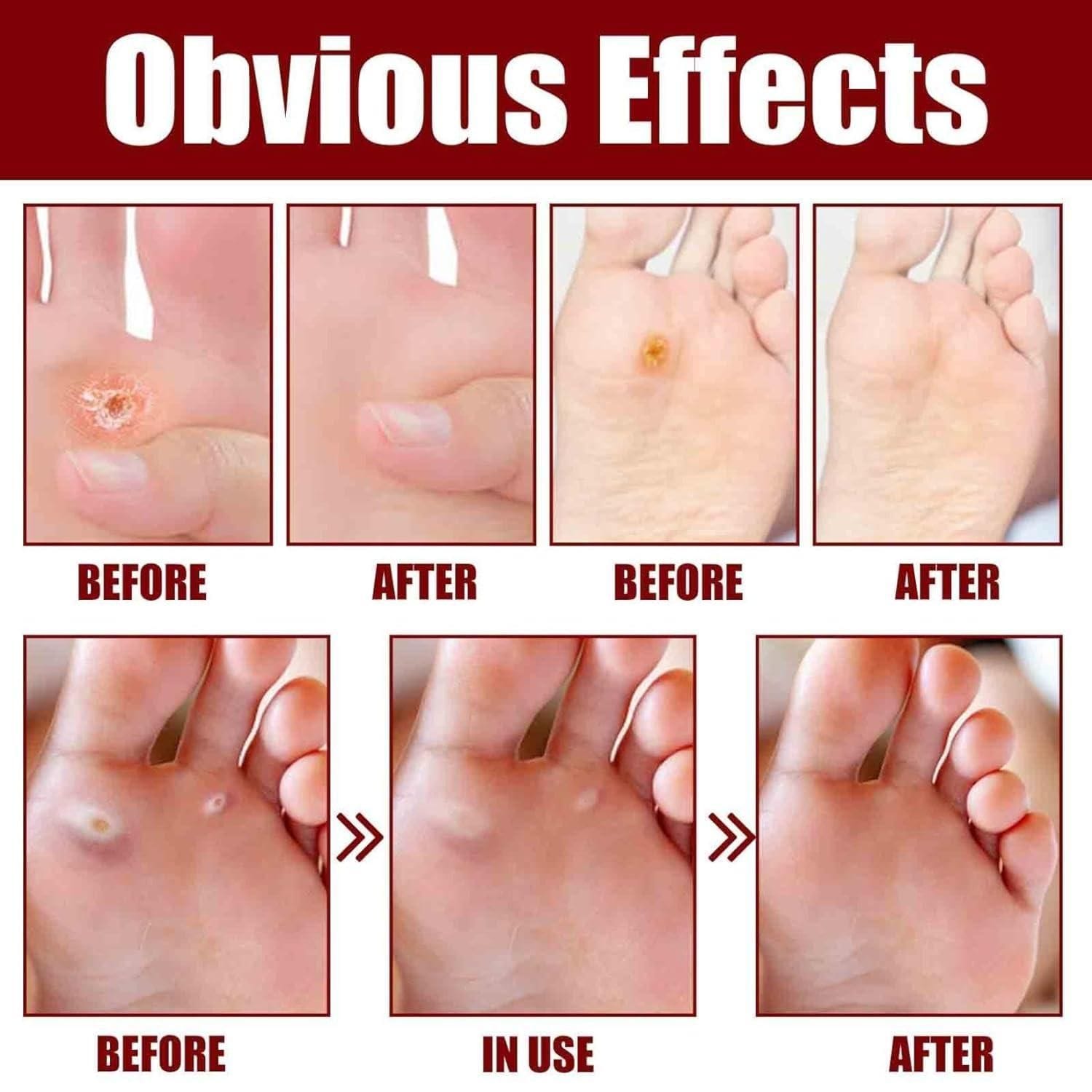 Feet Corn Removal Serum (Pack of 2) Feet Corn Removal Serum (Pack of 2) Zaavio®