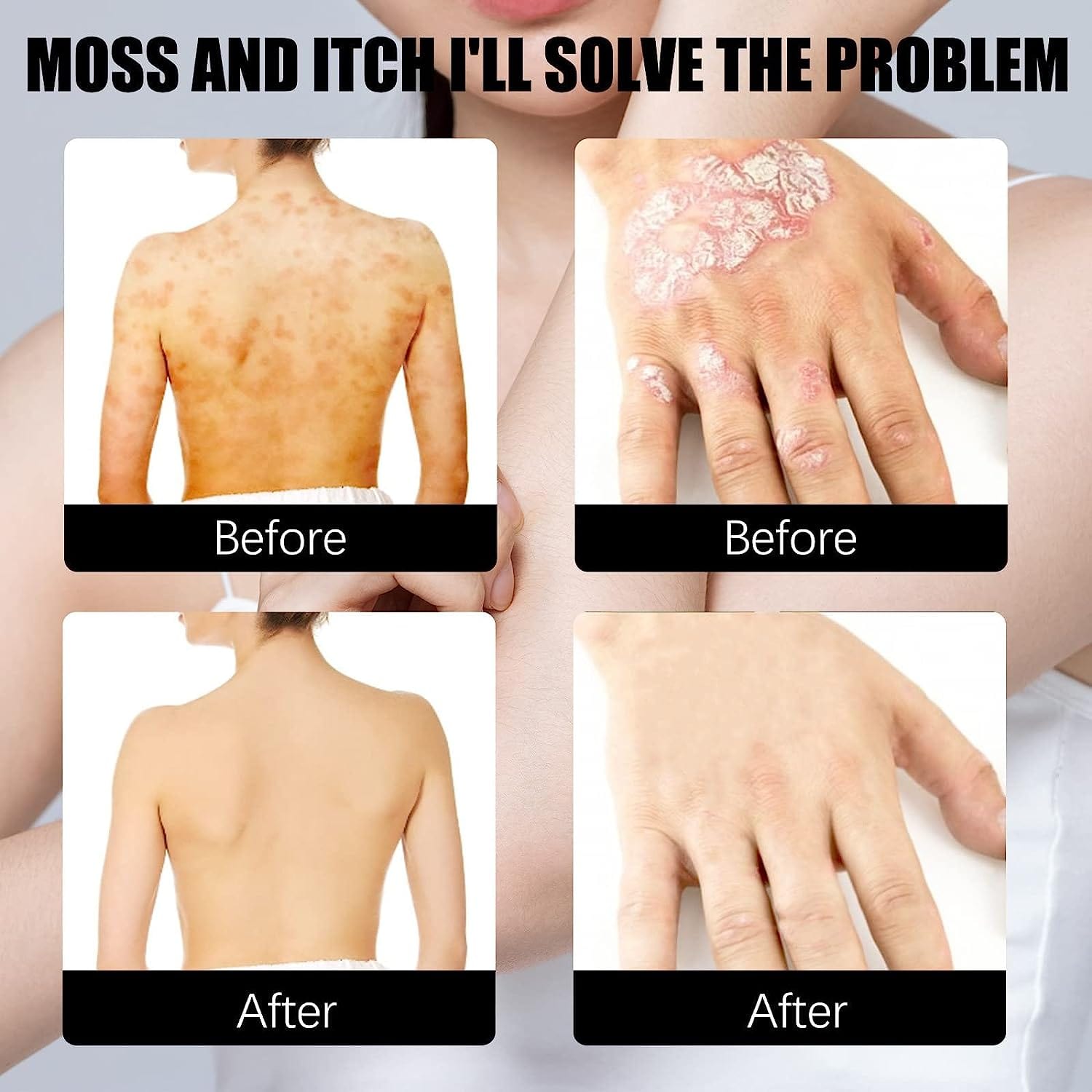Herbal Psoriasis Relief Spray Herbal Psoriasis Relief Spray