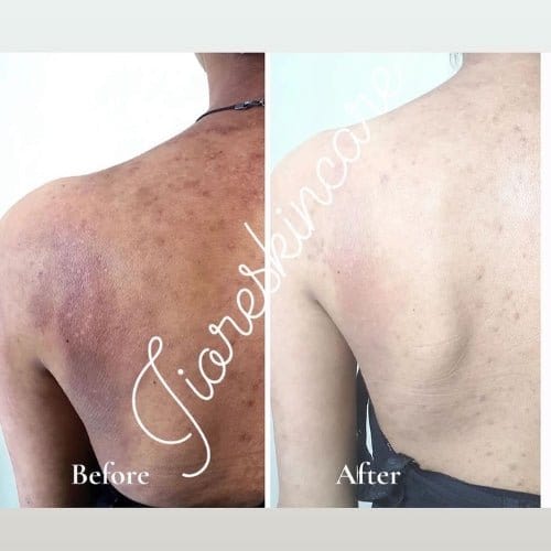 Kojic Body Soap | Skin Whitening Soap Dark Spots On Skin Tone Kojic Soap Whitening Kojic Body Soap (Set of 3)
