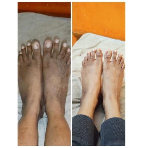 Kojic Body Soap | Skin Whitening Soap Dark Spots On Skin Tone Kojic Soap Whitening Kojic Body Soap (Set of 3)