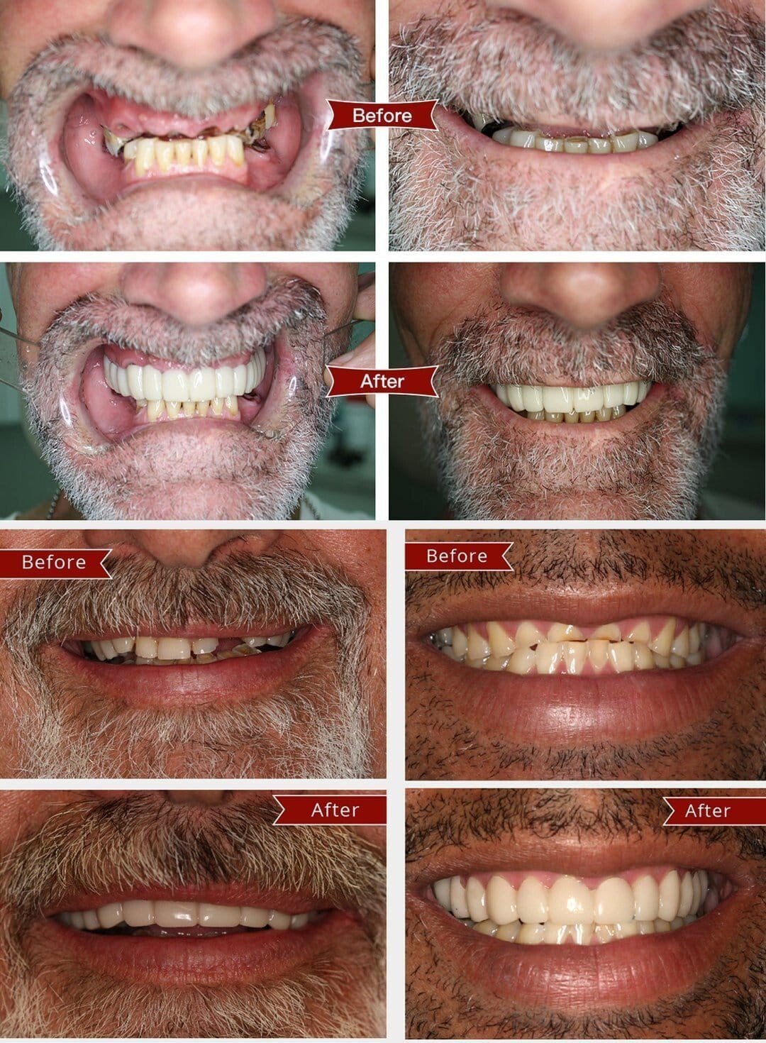 Snap-on Dentures | White Teeth Braces Clip On Veneer Teeth Perfect Dental Braces Snap-on Dentures