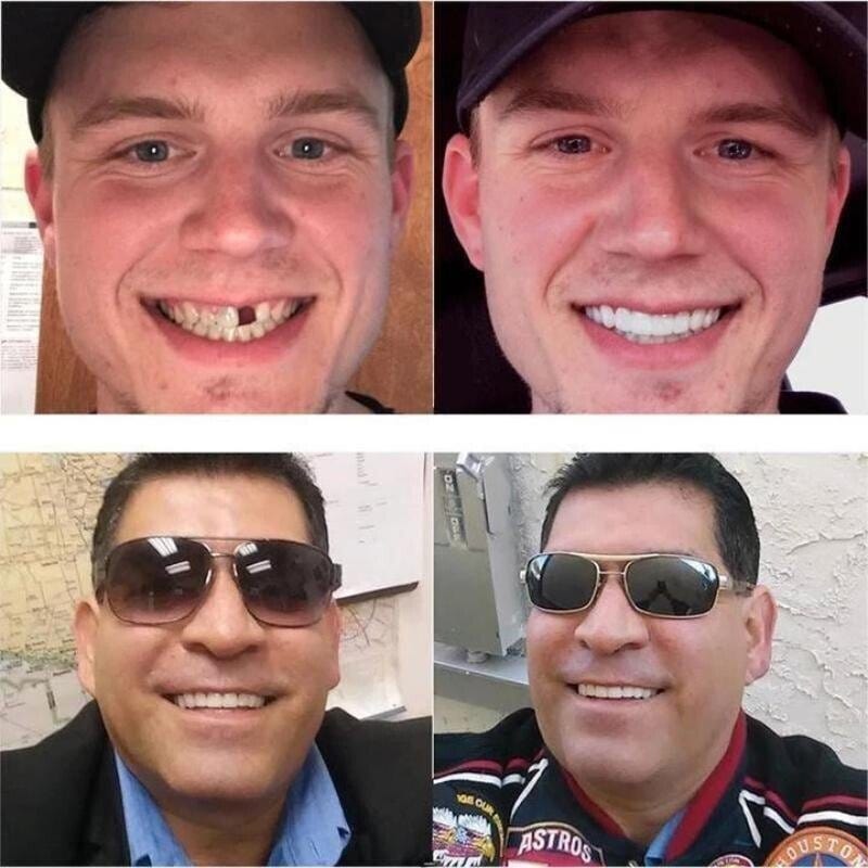 Snap-on Dentures | White Teeth Braces Clip On Veneer Teeth Perfect Dental Braces Snap-on Dentures