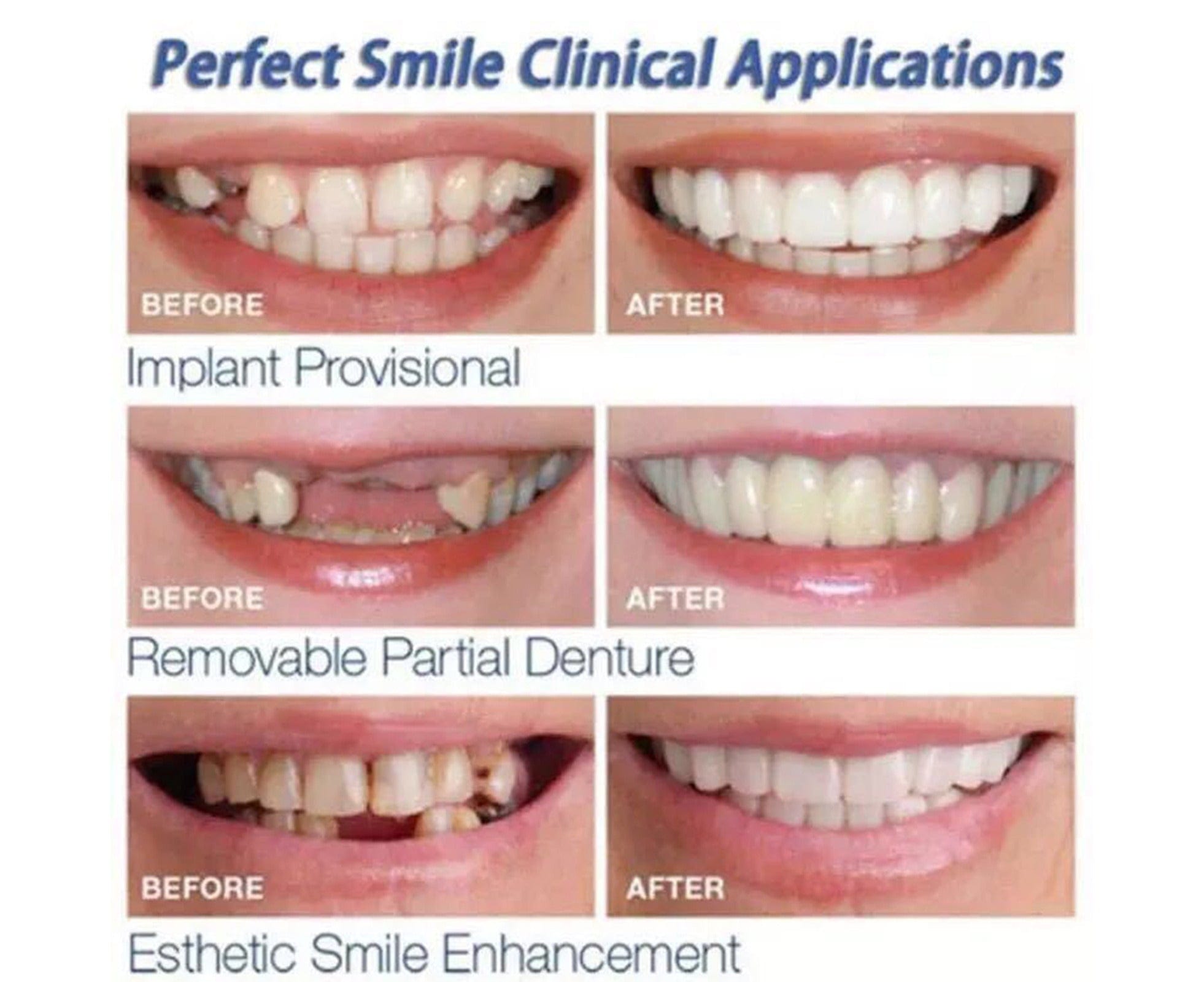 Snap-on Dentures | White Teeth Braces Clip On Veneer Teeth Perfect Dental Braces Snap-on Dentures