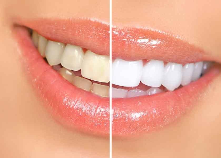 Teeth Whitening Tooth Paste Gel Whitening Pen Toothpaste- Purple Teeth Whitening Gel Purple Teeth Whitening Gel