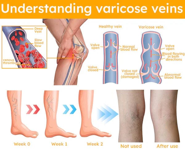 Varicose Veins Spray Bee Venom Varicose Veins Spray