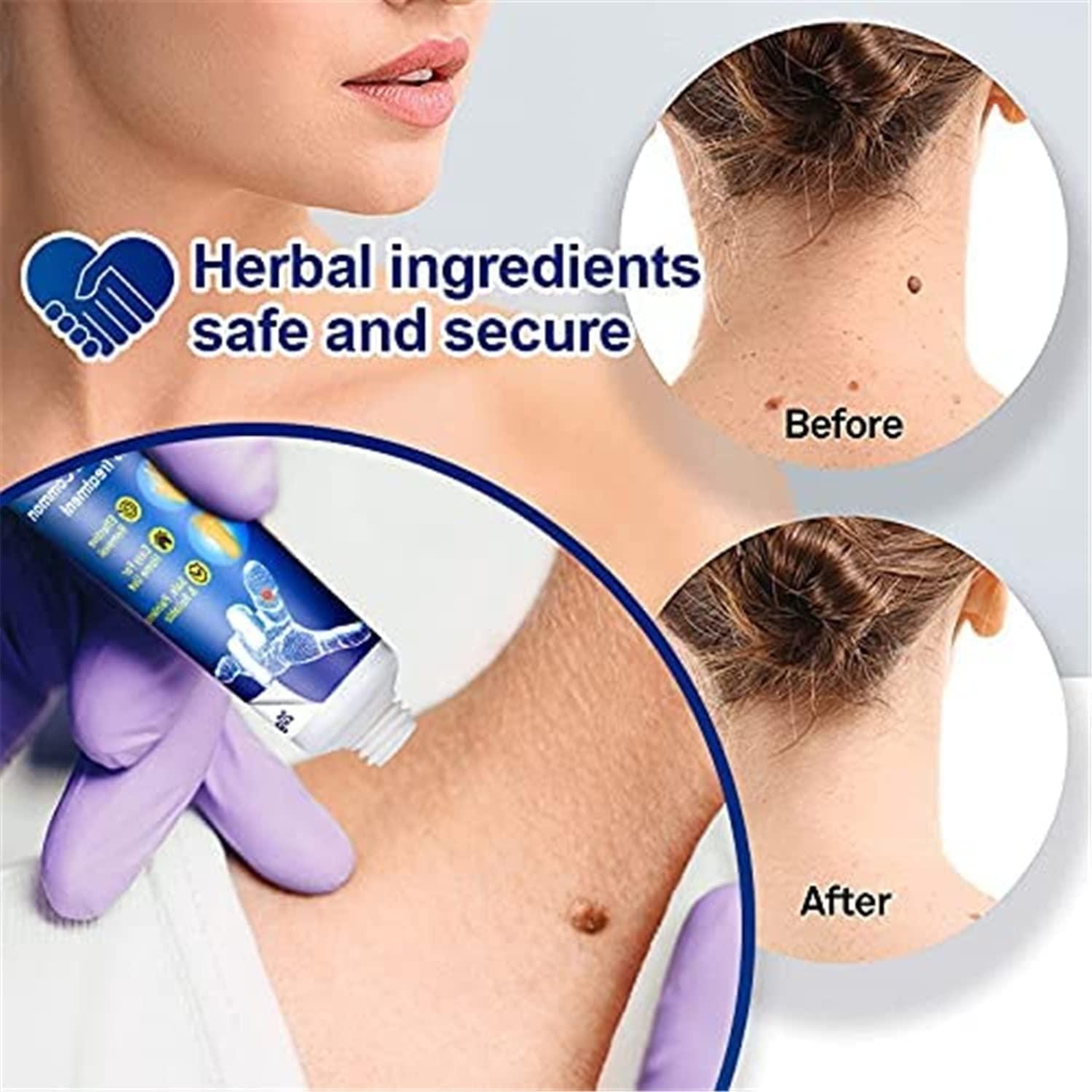 Wart Remover Ice Cream Mask Wart Remover Ice Cream Mask